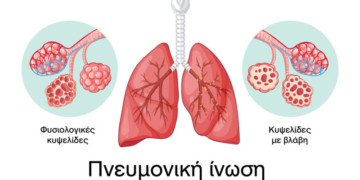 Η Περιφέρεια Κρήτης συμμετέχει και στηρίζει την εκστρατεία ενημέρωσης για την Πνευμονική Ίνωση